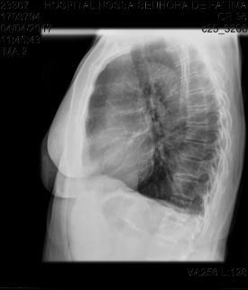 O laudo da radiografia foi descrito como moderado grau de insuflação pulmonar bilateral com opacidades reticulares grosseiras nos hilos e bases pulmonares, reforço brônquico em bases e sem sinais de