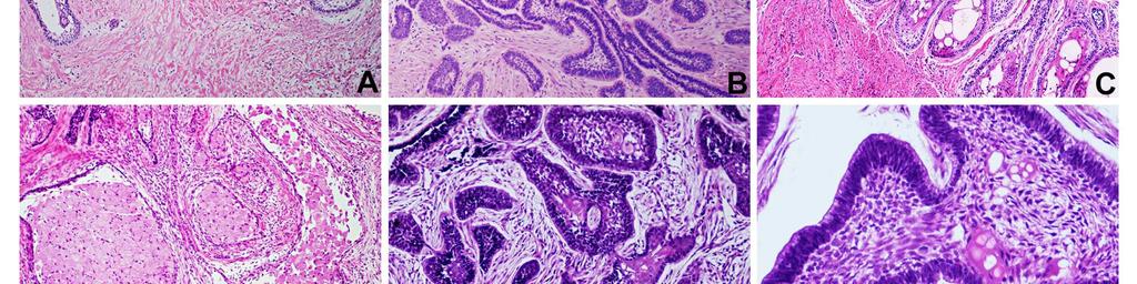 (H & E, aumento original X100) B: ilhas interconectadas de epitélio neoplásico formando aspecto plexiforme do ameloblastoma.
