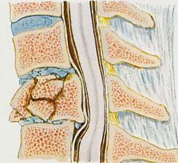 Hipotonia Tônus