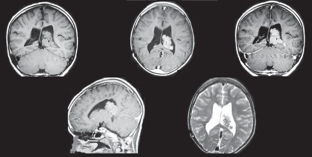 Nota-se também lesão isointensa em T1 axial no quiasma óptico (seta em B). Após injeção do contraste (), observa-se impregnação intensa, porém heterogênea.