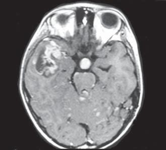 Incide principalmente na primeira década de vida. Localiza-se na fossa posterior, caracteristicamente preenchendo o quarto ventrículo, com cerca de 67 93% situados no vérmis cerebelar (1).