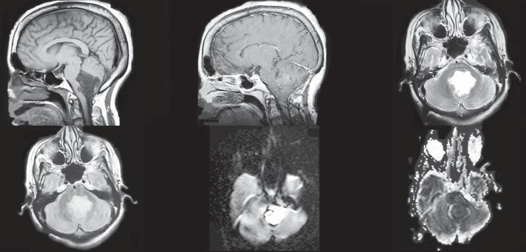 F Figura 8. Paciente do sexo feminino, 60 anos. RM sagital T1 (A) demonstra lesão cística com margens lobuladas, contornos irregulares e baixa intensidade de sinal.