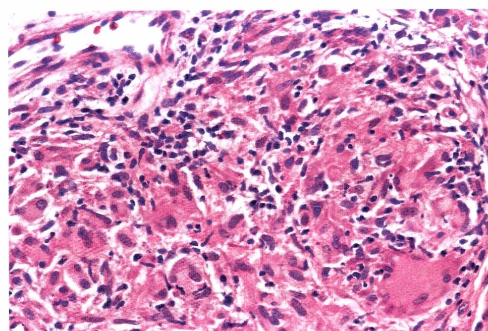 tuberculóide extensos e confluentes (HE - 50x).