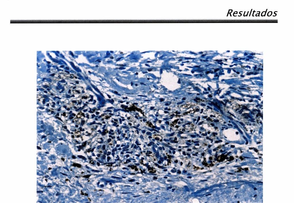 Figura 13 Reação granulomatosa mostrando células marcadas positivamente para a