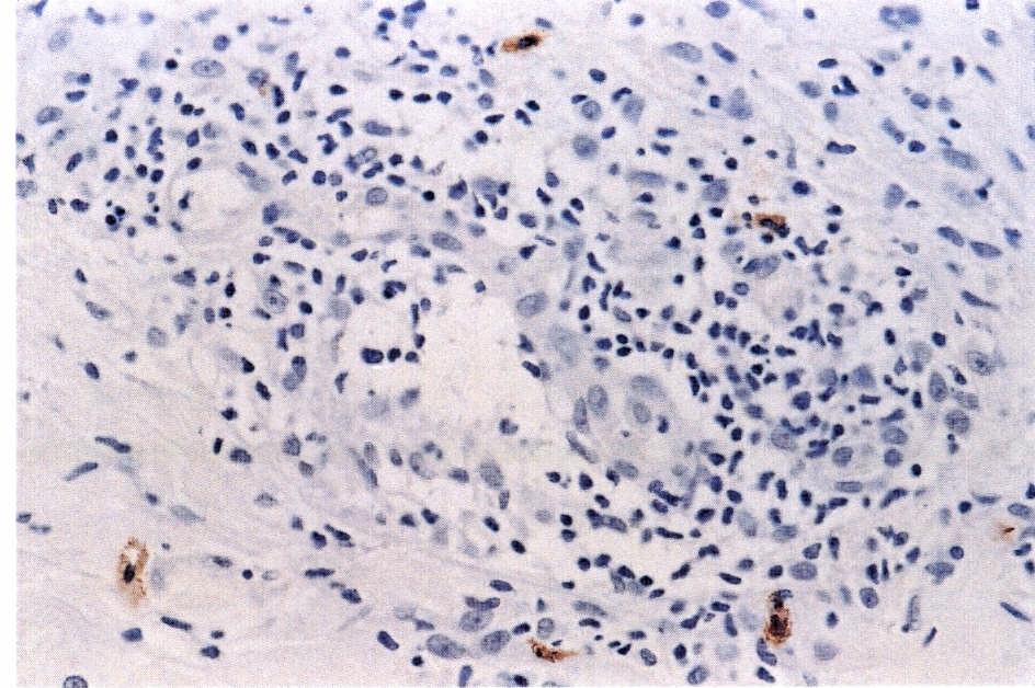 Figura 19 - Células mononucleares imunomarcadas para IL-10 em meio ao