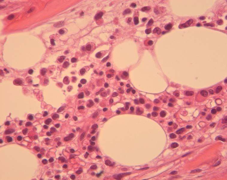 Bone marrow biopsy and cytogentics Hypocellular