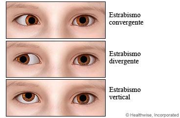 extrínseca dos olhos Alterações: assimetricas;