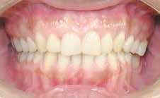 tratamento verificou-se a dentadura permanente com ausência do dente