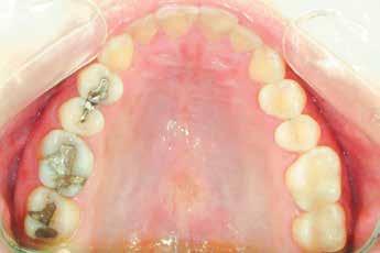 tratamento foi corrigir a má oclusão de lasse II dentária com a