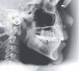(presença do dente 38, boa qualidade óssea/gengival na região e
