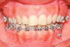 219 Sequência clínica O tratamento foi iniciado pelos dentes inferiores com a instalação do aparelho fixo pré-ajustado, prescrição Roth, ranhura 0,022 (Figura 4 -).