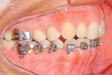esde o início do tratamento foi instalado um mini-implante da marca SIN, de diâmetro 1,6 mm, no rebordo alveolar, na região vestibular entre os dentes 34 e 35 e confeccionado um cantilever de