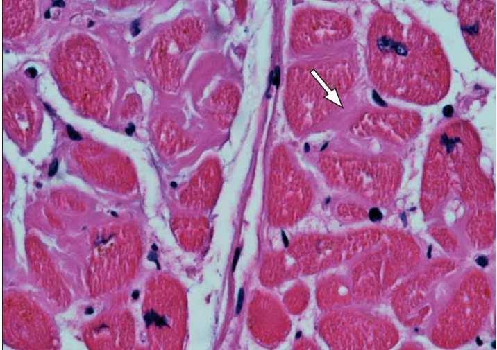 Amiloidose A amiloidose corresponde a um grande grupo de doenças no qual proteínas solúveis extracelulares são enroladas e depositadas como fibrilhas insolúveis nos tecidos, levando a