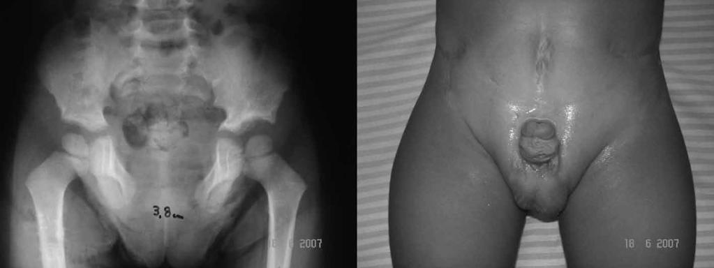 Segundo relato de caso O segundo paciente foi referenciado aos cinco anos de idade para correção de epispádia e realização de osteotomia pélvica.