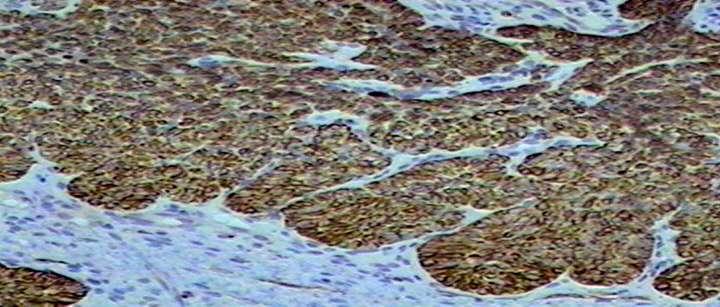 Imuno-histoquímica Padrão bifásico - áreas sólidas representadas por células neoplásicas com imunopositividade difusa com os anticorpos anti