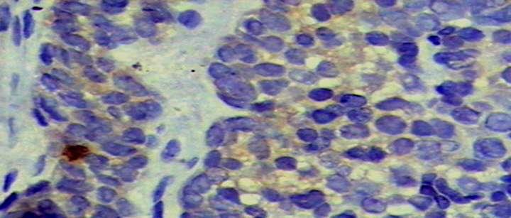 Imuno-histoquímica Padrão bifásico - áreas sólidas representadas por células neoplásicas com imunopositividade difusa com os