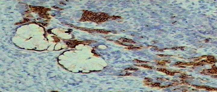 Imuno-histoquímica Padrão bifásico - áreas glandulares mucinosas representadas por células