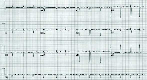 eletrocardiograma.