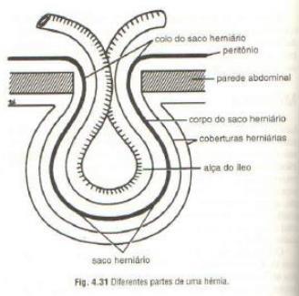 HÉRNIAS ABDOMINAIS Uma hérnia é a protrusão de parte dos conteúdos abdominais além dos