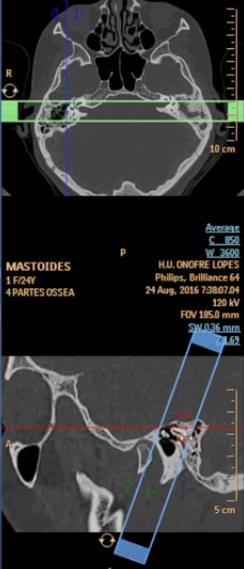 anterior a cóclea e ultrapassar o canal