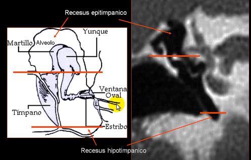 Anatomia Canal semicircular lateral Canal semicircular superior