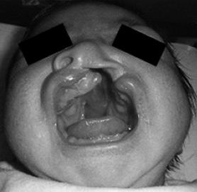 Progenitora traz paciente, com 2 meses de vida, encaminhado para avaliação da cirurgia plástica devido a fissura labial.