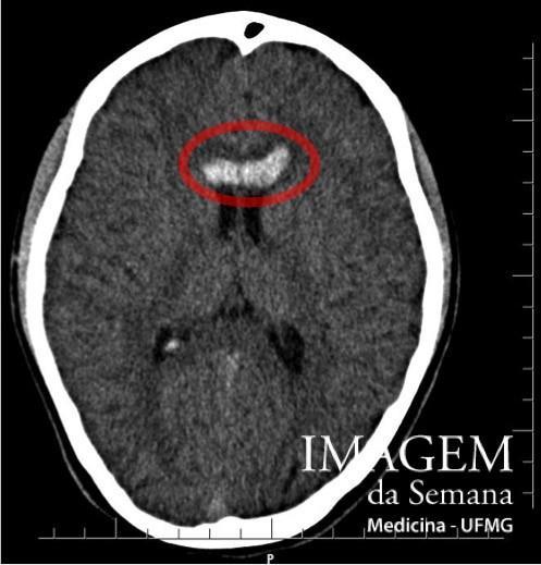 Tomografia Computadorizada (TC), Arteriografia Cerebral e Angioressonância Análise das Imagens Imagem 1: Tomografia computadorizada (TC) de encéfalo, sem injeção