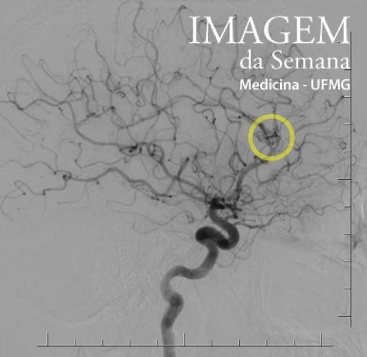 Imagem 2: Arteriografia, vista em perfil, da circulação cerebral anterior, realizada com injeção de produto de contraste intravenoso em artéria carótida