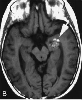 Imagem 5: Ressonância magnética (RM), que, em ponderação T2, mostra imagem típica em pipoca, devida à heterogeneidade formada pelas bordas de hemossiderina