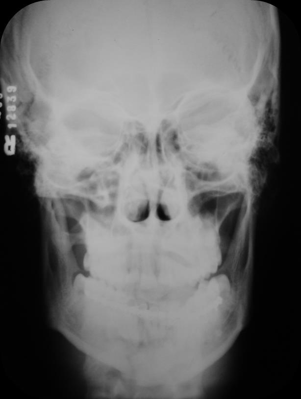 Figura 1: Radiografia póstero-anterior da face mostrando a