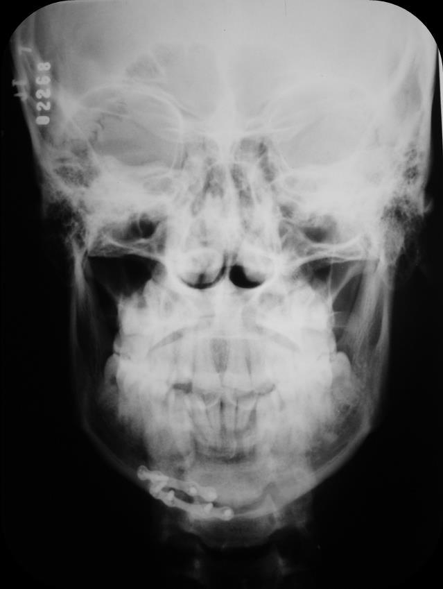 19 Figura 2: Radiografia posteroanterior da face mostrando a redução cirúrgica da fratura mandíbular.