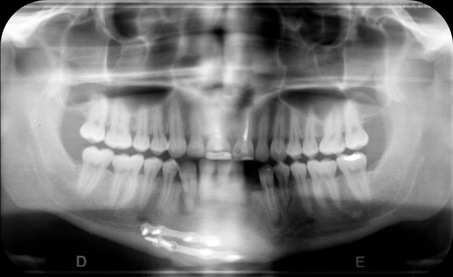 20 radicular externa. Duas placas e parafusos de fixação cirúrgica na porção anterior da mandíbula que foram usadas para estabilizar a região fraturada.