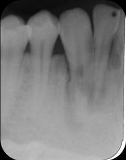 21 Figura 4: Radiografias periapicais Ao