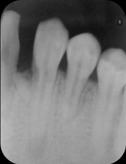 42 e 43 sugerindo lesão periapical.