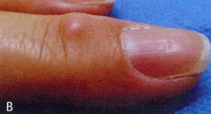 Mão Mão artrose