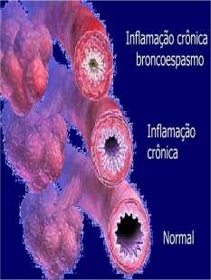Epidemiologia do Bronoespasmo perioperatório Asurvey of perioperative broncshospasm in 105 patients with reactive airway disease.