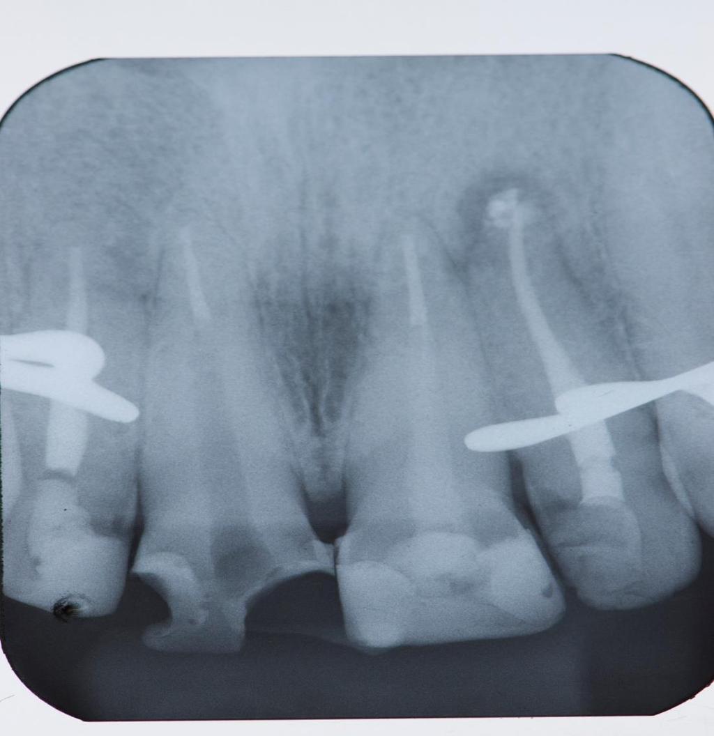 Procedimento Tamanho do dente: 26mm(foi medido do remanescente coronário ao ápice dentário; Tamanho da raiz: 22mm;
