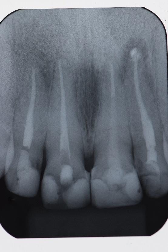 PROCEDIMENTO Durante o exame clínico e radiográfico, observou-se um dente com bastante perda de estrutura coronária,onde não se tinha estruturas suficientes para as cargas mastigatórias, optou-se por