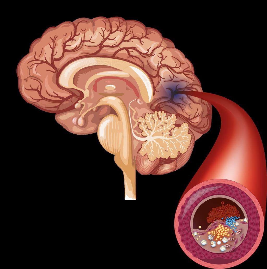 Capítulo 3 FISIOPATOLOGIA DO AVC ISQUÊMICO O processo de morte neuronal através da isquemia ocorre, em geral, quando o fluxo sanguíneo em determinada região do cérebro alcança níveis críticos,