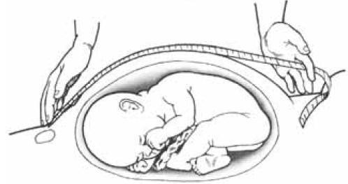 Técnica de medida da Altura Uterina (AU) Psicinar a gestante em decúbit drsal, cm abdômen descbert; Delimitar a brda superir da sínfise púbica e fund uterin; Pr mei da palpaçã, prcurar crrigir a cmum