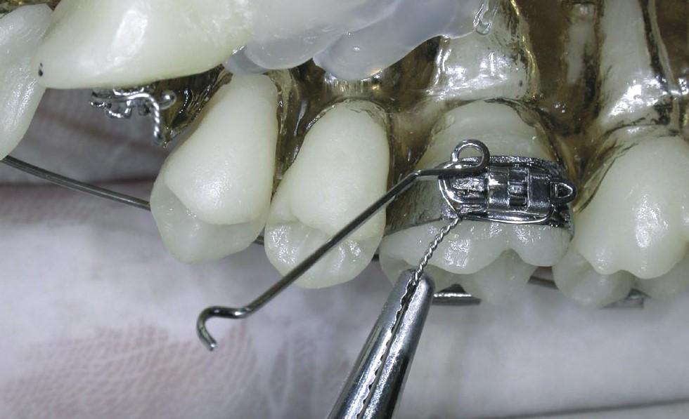 Após a confecção o cantilever é posicionado no tubo lingual do primeiro molar superior e a ativação é realizada com o mesmo alicate, de modo que o gancho de encaixe do cantilever fique a dez
