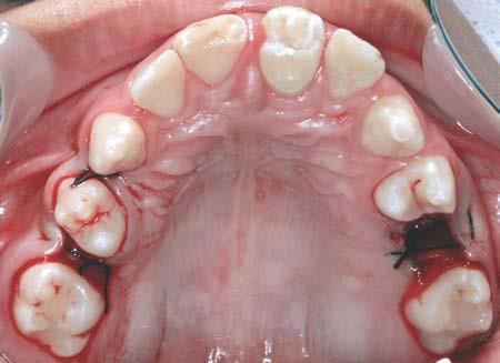transplantado para um alvéolo artificial realizado no rebordo alveolar. Nesta manobra a necrose pulpar e a reabsorção radicular são freqüentes, havendo risco de perda do dente transplantado.