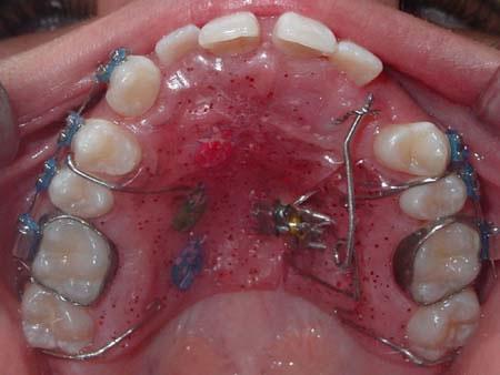 Figura 9 - Aparelho ortodôntico removível. Fonte: www.ortoperfil.com.br/casosclinicos Caninos impactados por palatino raramente irrompem sem intervenção cirúrgica.