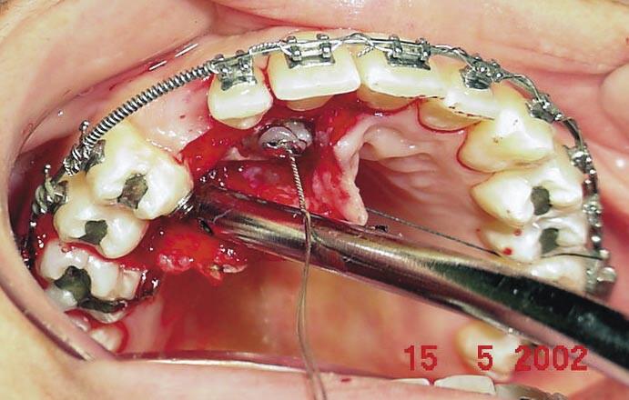 Este procedimento consiste em acessar o canino impactado para a fixação do acessório ortodôntico e utilizar na mecânica até seu posicionamento no arco dentário.