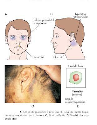 Sinais e Sintomas de TCE Fratura de base de crânio: rinorréiaotorréia e equimose Periorbital (olhos de guaxinim ) Equimose retro auricular Convulsão Irritação meníngea: cefaleia, rigidez de nuca,