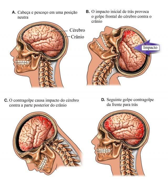 Traumatismo cranioencefálico Causado devido um impacto na cabeça, lesionando estruturas internas e/ou externas.
