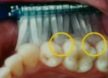 Figura 9. A escova não alcança a região interproximal dos dentes. Se faz necessário a utilização de fio dental.