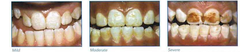 O consumo excessivo de flúor durante o período de desenvolvimento dos dentes pode causar fluorose dentária, resultando num esmalte hipomineralizado, com maior porosidade.