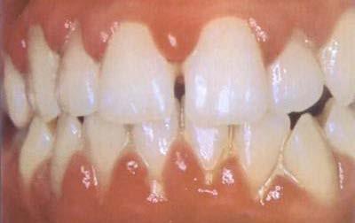 sondagem e pela perda de inserção osso, cemento e ligamento periodontal resultando disso a formação de bolsa periodontal. Figura 19. Gengivite. Figura 20. Periodontite.