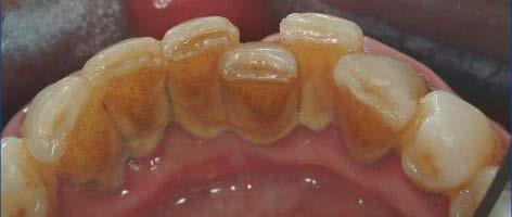 A etiologia da doença periodontal e gengival é microbiana, sendo agravada quando a higiene bucal é negligenciada.
